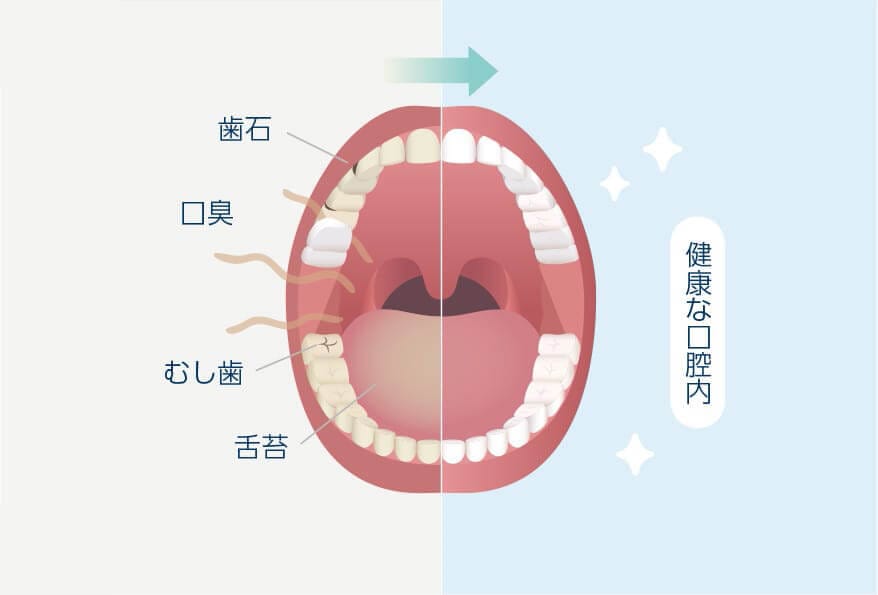 口腔内をキレイにする  