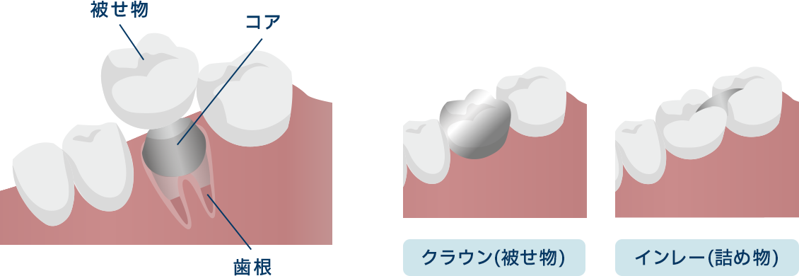 歯の修復