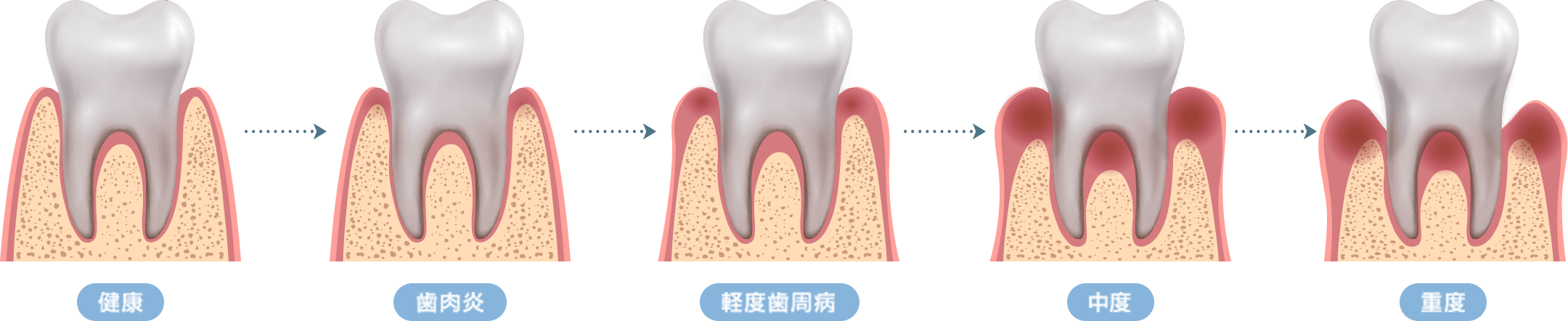 歯周病の進行度