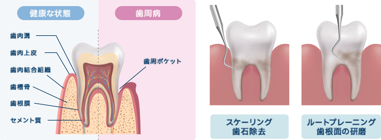 歯茎の治療