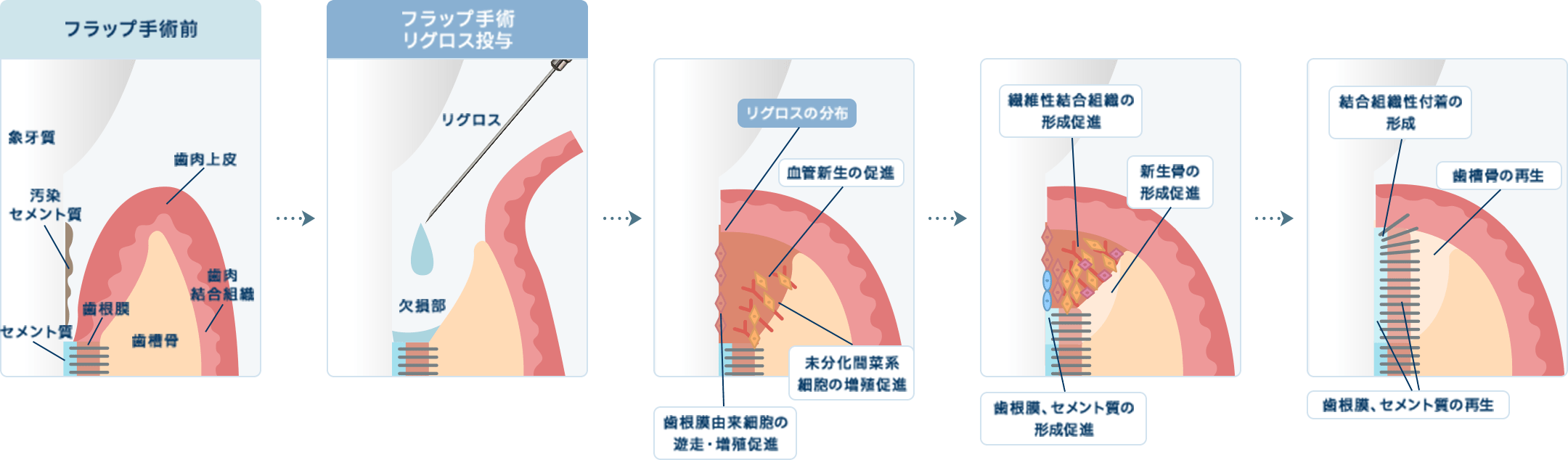 歯周組織再生療法の流れ