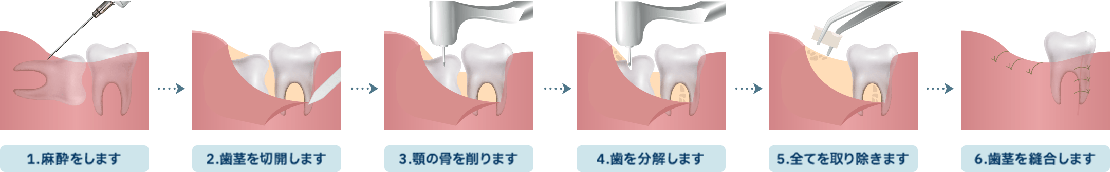 親知らず抜歯の流れ