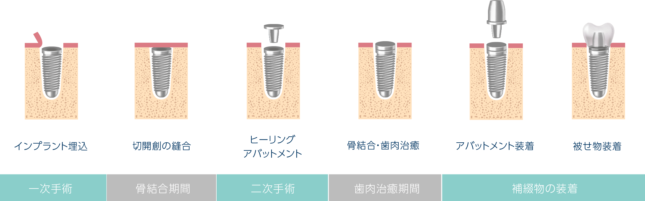 「位置・深さ・方向」を確認する正確なインプラント埋入