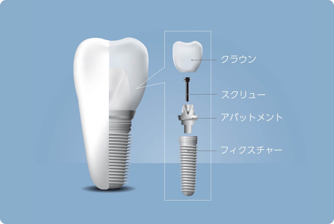 支柱・連結部・人工歯で支えるインプラント構造 インプラント外科