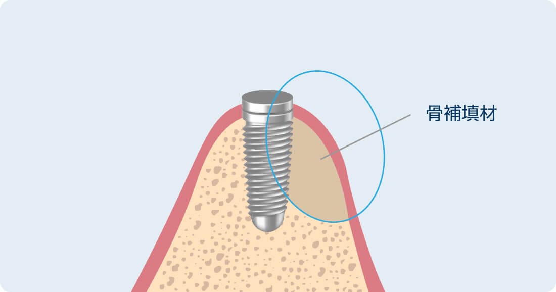 骨再生誘導療法（GBR）