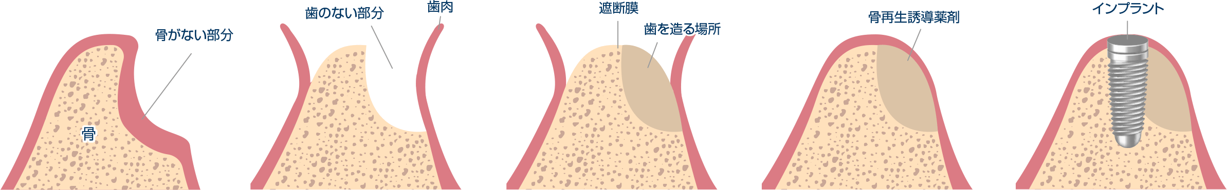 骨再生誘導療法（GBR）