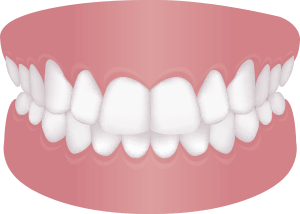 上の前歯が出ている (上顎前突)