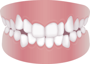 歯がでこぼこしている (叢生)