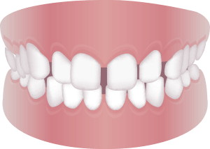 すきっ歯である （空隙歯列）
