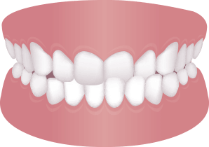 上下の歯列が横に ずれている（交叉咬合）