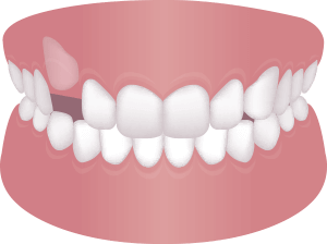 歯が骨に埋まって 生えてこない（埋伏歯）