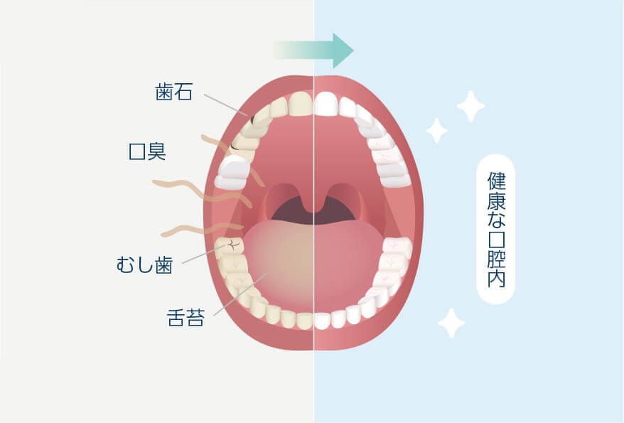 口腔内をキレイにする  